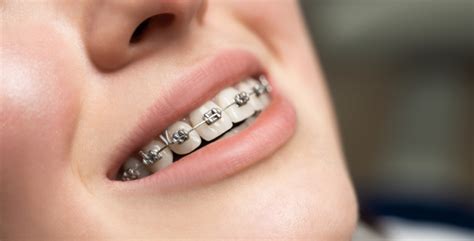 brackets metalico|que es un bracket metal.